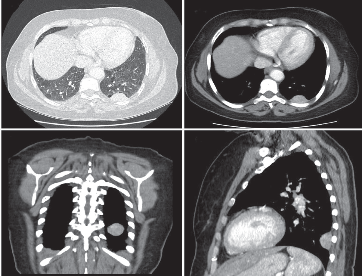 Angio-tomografia computorizada torácica: A1 e A2: Plano transversal; B: Plano coronal; C: Plano sagital
