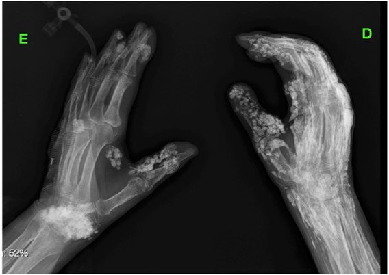 Radiografia das mãos com múltiplos nódulos radiopacos, bem delimitados, no tecido subcutâneo correspondendo a calcinose cutânea.