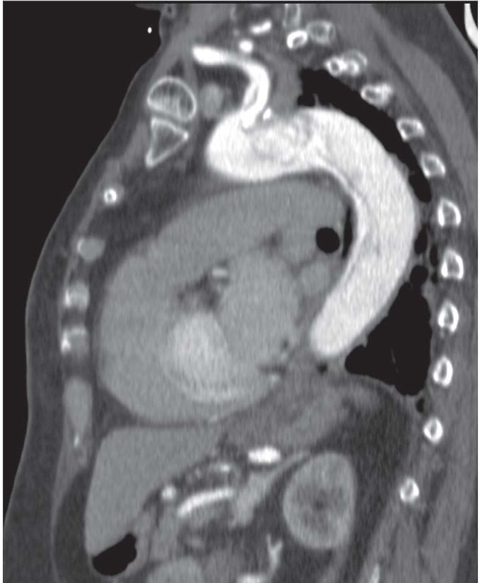 Imagem de tomografia computorizada (TC) toracoabdominal em corte sagital onde é possível observar a extensão da disseção, incluíndo a origem da artéria carótida (seta), ao longo de todo o trajeto da aorta torácica.