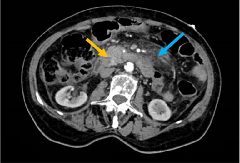 Abdominal and pelvic CT with contrast showed a pancreas with an enlarged cephalic portion (yellow arrow) with irregular contrast distribution and moderate densification of peripancreatic fat (blue arrow) and thickening of the renal fascia bilaterally.