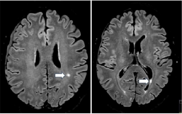 Axial FLAIR-weighted brain magnetic resonance images – (A) Evidence of a left parietal subcortical hypersignal focus (arrow). (B) Evidence of a left posterior periventricular hypersignal focus (arrow).