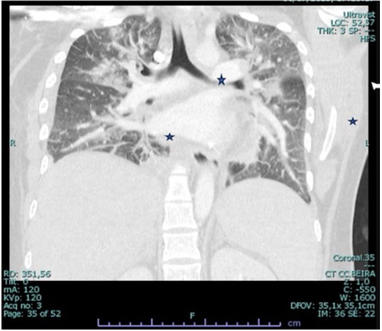 TC tórax em plano coronal, evidenciando proeminência dos ramos das artérias pulmonares e ramos segmentares e subsegmentares (estrela) e áreas em vidro despolido com distribuição peribroncovascular (seta branca).