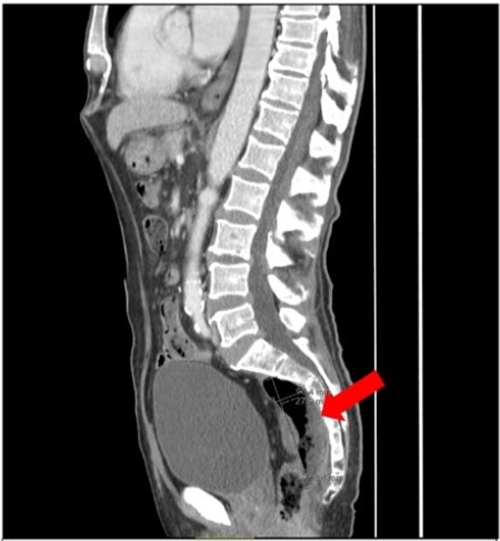 Sagittal section of abdominal computed tomography (CT) with presacral collection measuring about 90 x 66 x 28.