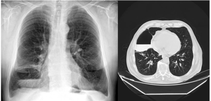 Lung abscess before treatment. Chest radiography (left picture), postero-anterior incidence, showing a round opacity in the lower zone of the right hemithorax, with air-fluid level. Thorax CT scan (right picture), showing bilateral emphysema, a round air-fluid densification in the right lower lung lobe, and a minimal right pleural effusion.