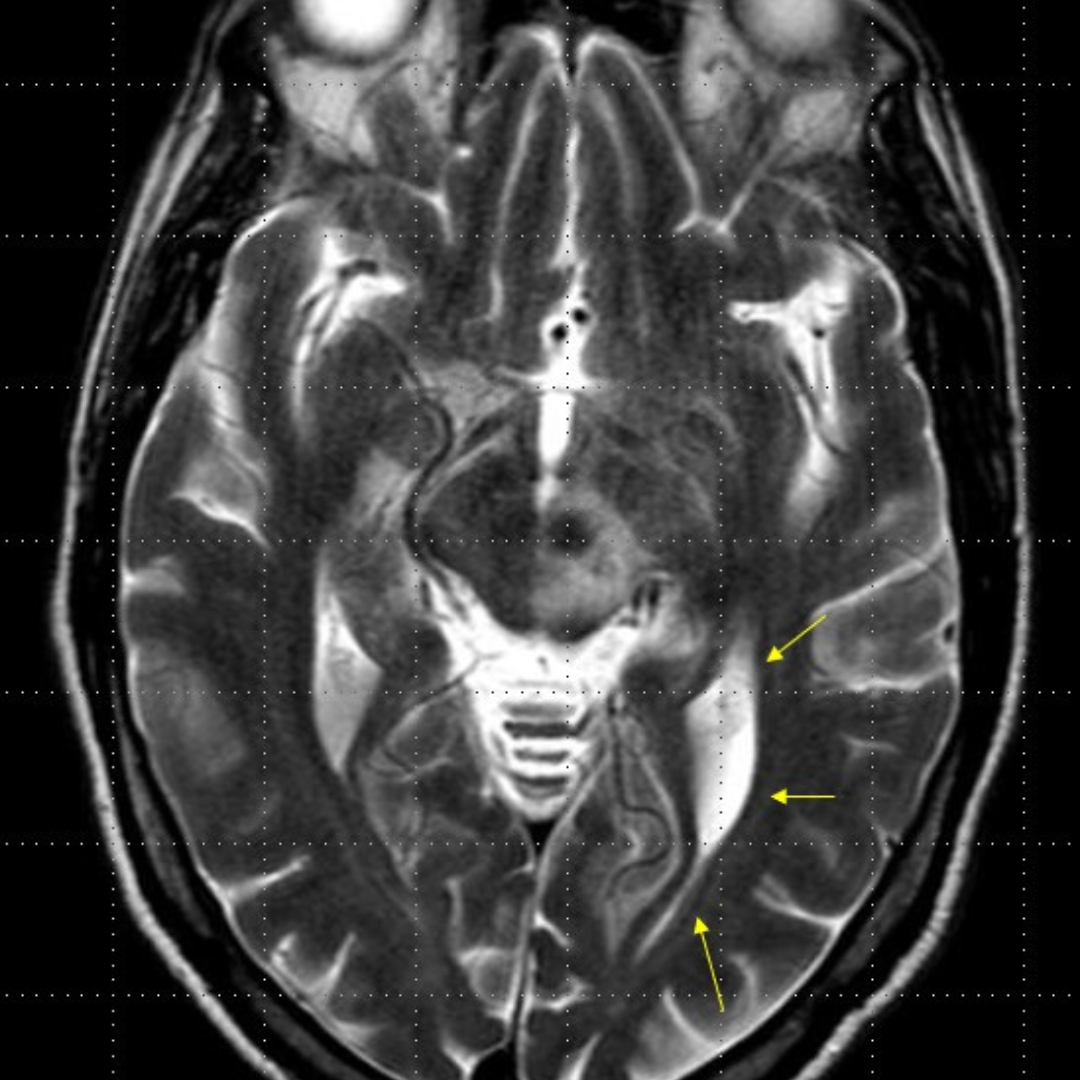 Extensive T2/FLAIR hypersignal in the posterior aspect of the inner capsule, thalamus, corona radiata at brain MRI.