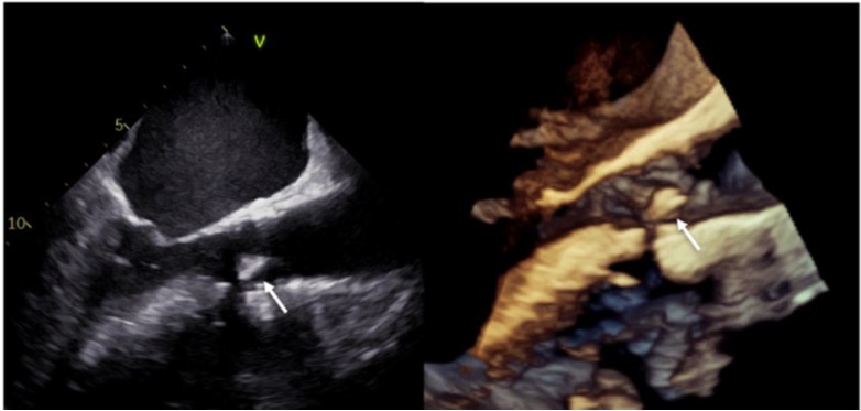 Ecocardiograma transesofágico evidenciando lesão acoplada à válvula aórtica.