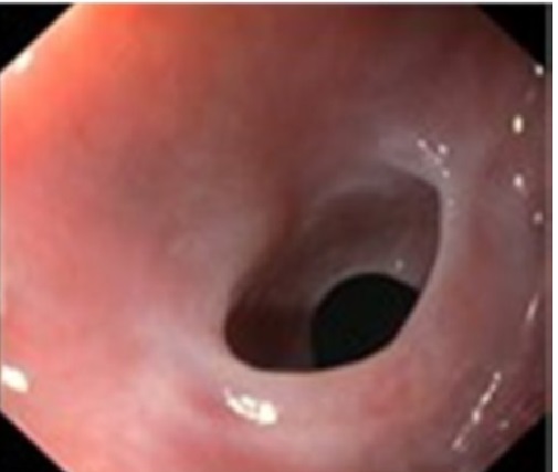 Endoscopia digestiva alta – Presença de estenoses condicionadas por membrana mucosa circunferencial.