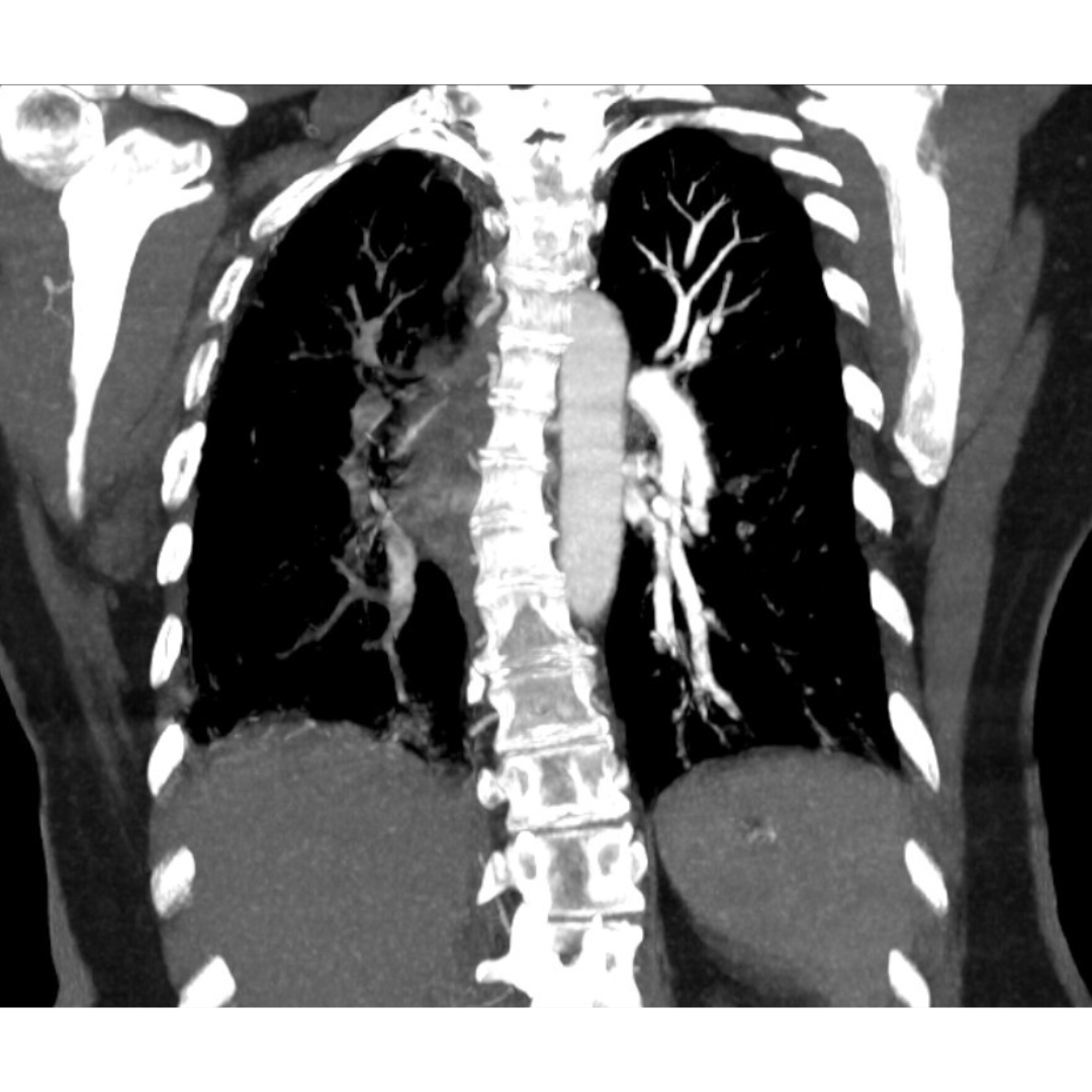 Reconstrução coronal em janela de partes moles. Na imagem observa-se clara assimetria na vascularização pulmonar, não se demonstrando opacificação de estruturas vasculares pulmonares no pulmão direito (normal no pulmão esquerdo).