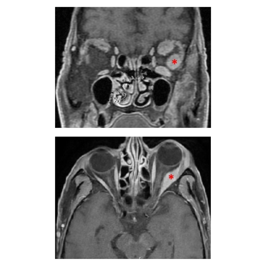 Magnetic resonance imaging of the orbits: bilateral thickening and increased enhancement of the pre-septal periorbital soft tissues and extraocular muscles (*) that is more pronounced on the left, compatible with inflammatory changes.