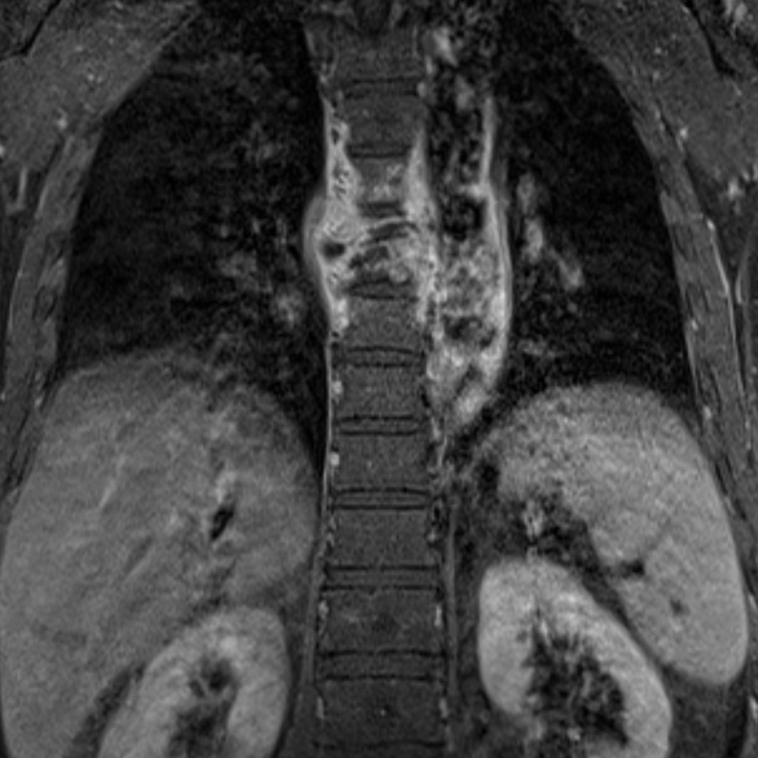 Ressonância magnética da coluna dorsal, corte coronal, com colapso total de D6, espaço D6-D7, e parcial do corpo de D7, com hipossinal T1,T2 e hiperssinal T2 STIR; Componente tecidular pré e peri-vertebral bilateral D5-D8, com extensão epidural ântero-lateral bilateral.