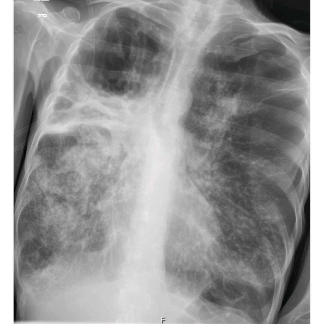 Radiografia torácica postero-anterior. Evidência de áreas hipotransparentes em ambos os ápices, região de maior densidade no hemitoráx superior direito, delimitada pela cissura, e hipotransparências heterogéneas na metade inferior de ambos os campos pulmonares.