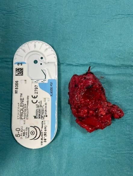 Paraganglioma after laparatomic excision with 5-0 sutures for size reference.