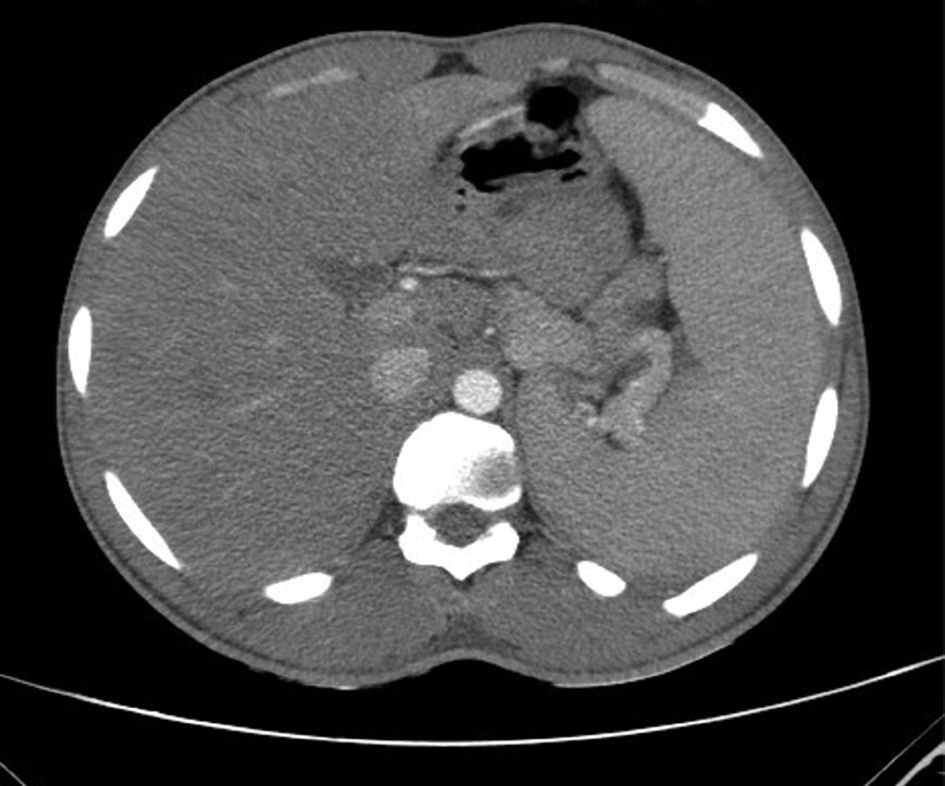 CT scan showing marked splenomegaly (19.6 x 19.5 x 7.6 cm).