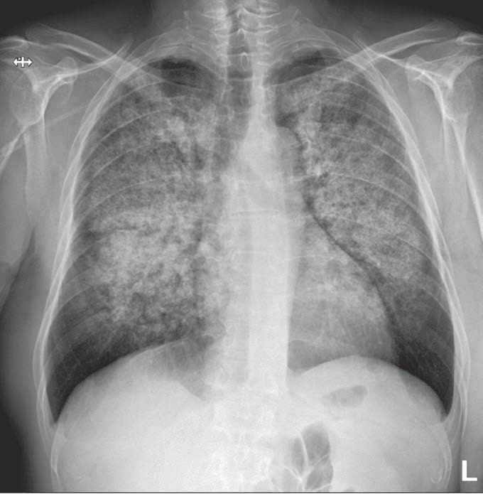 Radiografia do tórax postero-anterior, na qual se destaca um infiltrado difuso bilateral reticulo-endotelial que poupa as bases, com seios costo-frénicos livres.