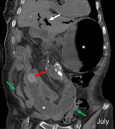 Contrast CT of the abdomen and pelvis in the coronal plane at the time of admission demonstrating an impacted endoluminal calculus with 2 cm in the small bowel (red arrow). Notice the upstream dilatation of the small bowel (*) and stomach (*) and the normal caliber of the colon (green arrows), meaning a mechanical obstruction is present. The biliary tree is also dilated and with pneumobilia (white arrow), meaning a probable fistula with the small bowel was present, in this case a choledocoduodenal.