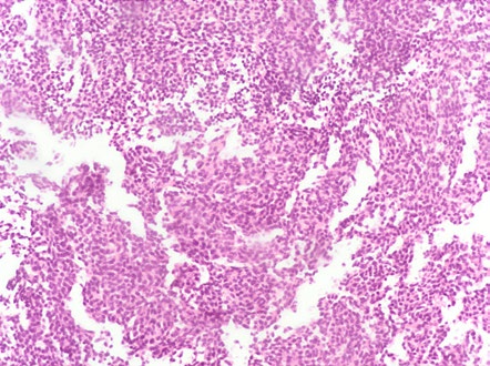 Biópsia de massa mediastínica anterior - Tumor carcinoide atípico - escassos focos de necrose e cerca de 3-4 mitoses, população tumoral CK AE1/AE3 (+), CD56 (+), sinaptofisina (+) e TTF-1 (-). Expressão de Ki67 de 10%.
