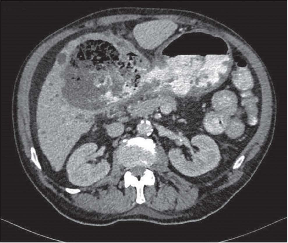 Observa-se uma úlcera penetrante do estômago, com trajecto gastro-hepático evidente pelo extravasamento de contraste do lúmen do estômago para um abcesso hepático.