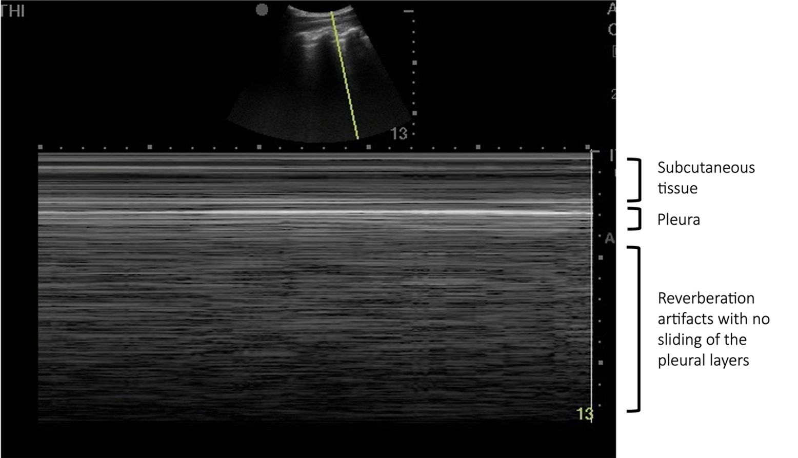 Figure 1 - Ultrasound of the left thorax in M-mode showing the barcode/stratosphere sign