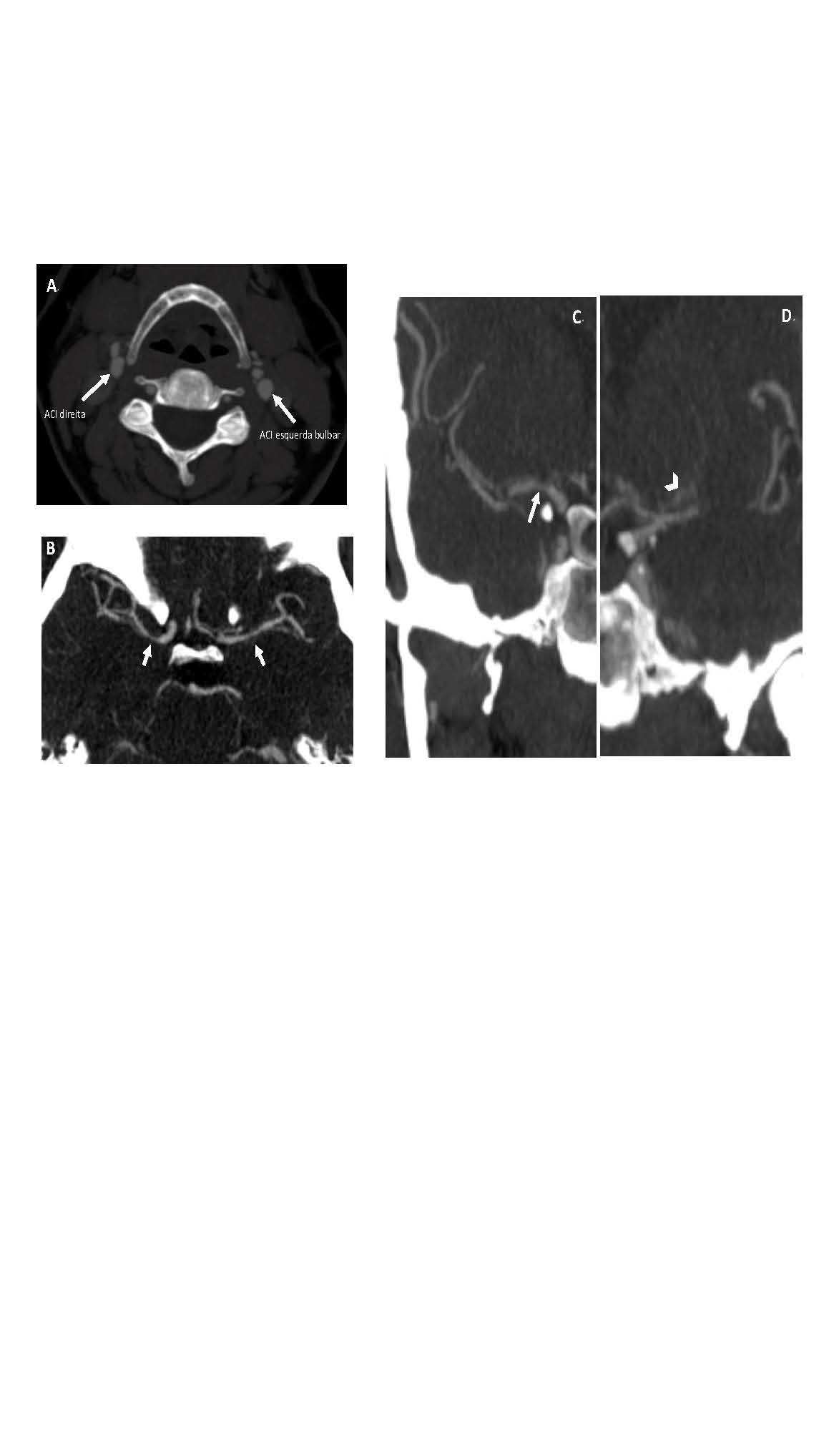Figura 1 - Angio TC CE: A (Plano axial) – bifurcações carotídeas sem placas de ateroma ou sinais de dissecção;B (Plano axial) - Estenose dos segmentos M1 das artérias cerebrais médias;C (Plano coronal) - Estenose da origem dos segmentos M1 (      ) e A1 (      ) das artérias cerebrais média e anterior, respectiva-mente.D (Plano coronal) – À esquerda, hipertrofia das artérias lenticulo-estriadas (      ).ACBD
