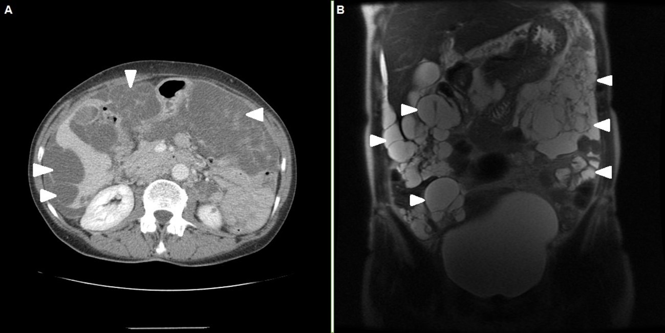 Figure 1 - Panel A – Axial thoracoabdominopelvic computed tomography scan with multiloculated cystic lesions with solid  component. Panel B – Coronal T2-weighted magnetic resonance imaging showing multicystic masses. Lesions are identified by  arrowheads in both panels.