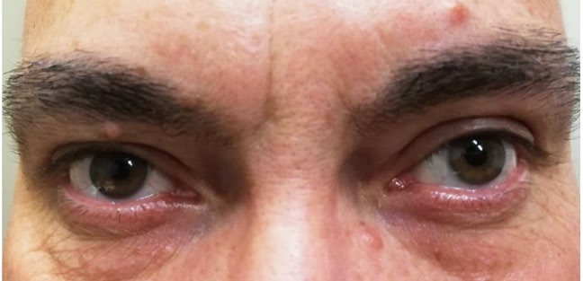 The patient presented 1 mm right ptosis and slight anisocoria in room light at hospital admission